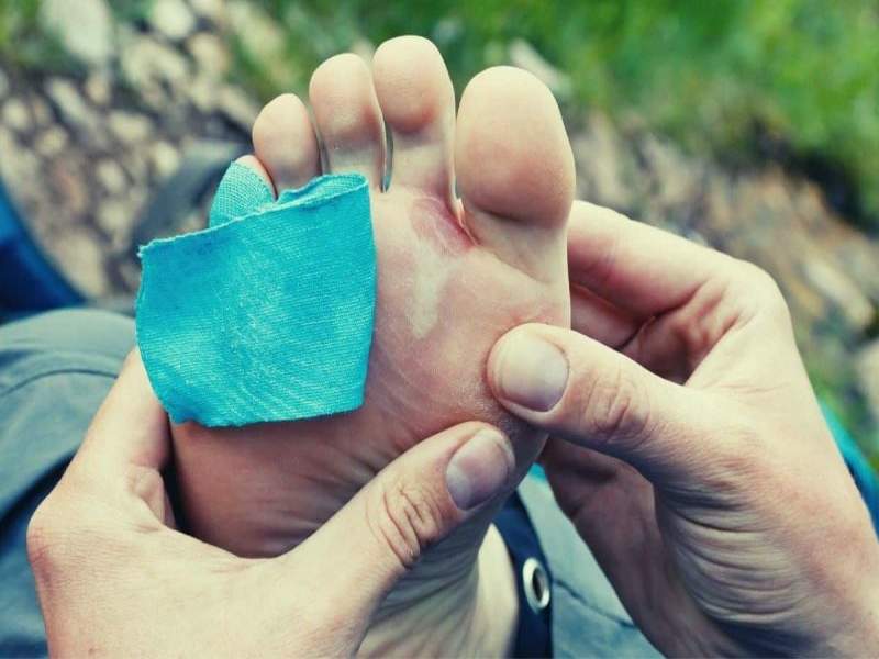 تاول پا و درمان فوری آن در پیاده‌روی اربعین